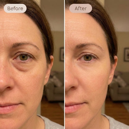 Mira Eye Recovery PRO