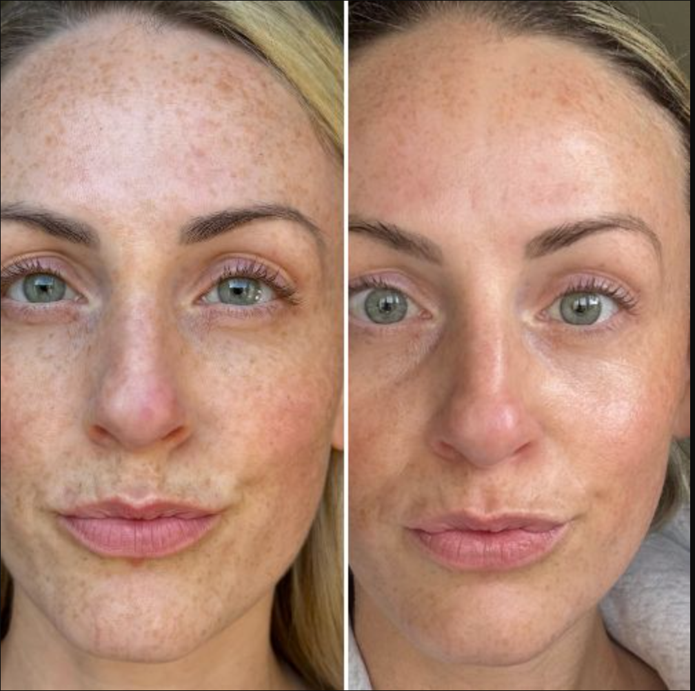 Mira Eye Recovery PRO