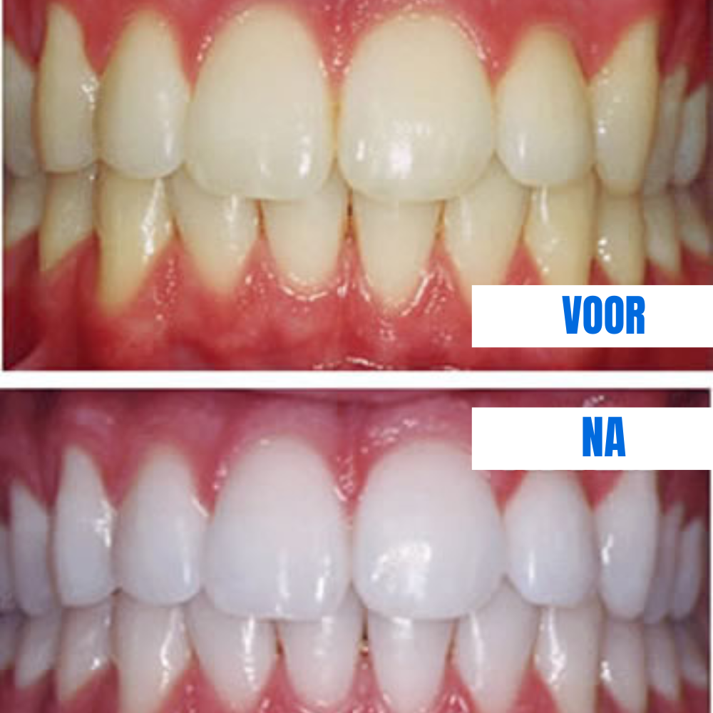 SmileLuxe Pen Klinisch Geïnspireerde Formule met Peroxide-Duo en Xylitol