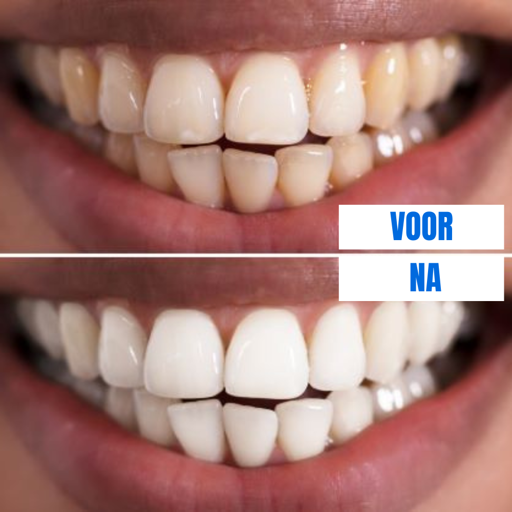 SmileLuxe Pen Klinisch Geïnspireerde Formule met Peroxide-Duo en Xylitol